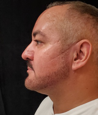 Liposuction-Case--368 | After Liposuction 2