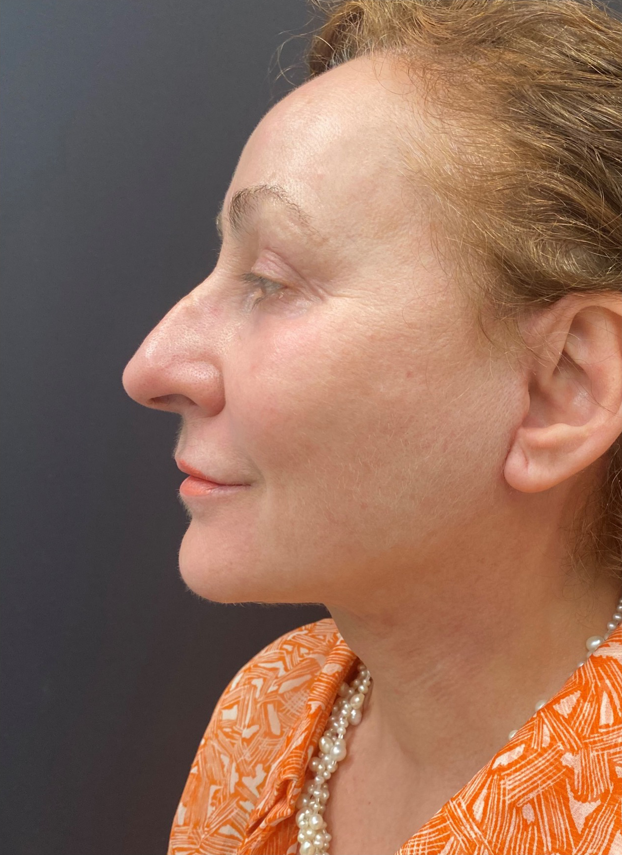 Facelift-Case--363 | After Facelift 2