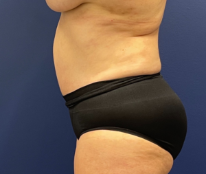 Abdominoplasty-Case--21804 | After Tummy Tuck 2