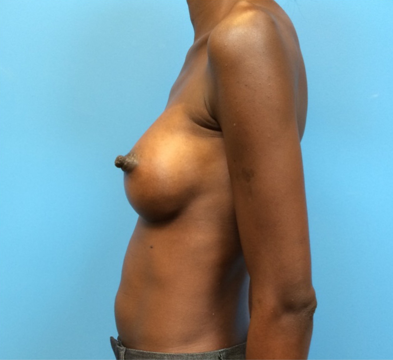 Case--97 | After Breast Augmentation 2
