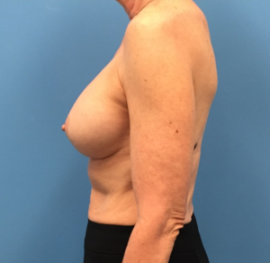 Revision-Breast-Augmentation-Case--237 | After Revision Augmentation 2