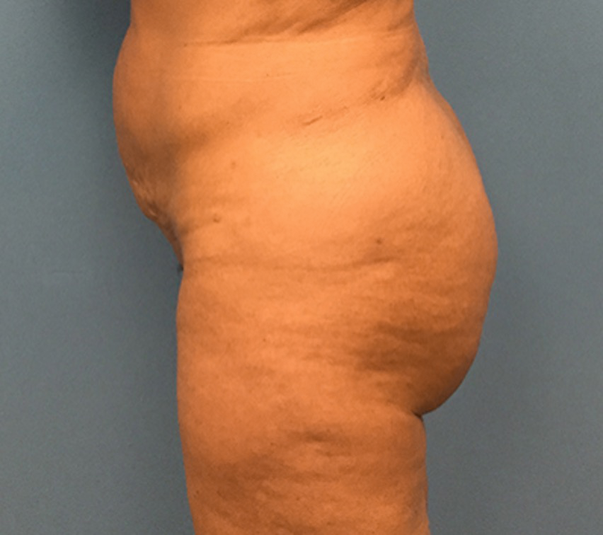 Brazilian-butt-lift-Case--74 | After Brazilian Butt Lift 1