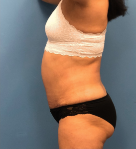 Case--14819 | After Liposuction 2