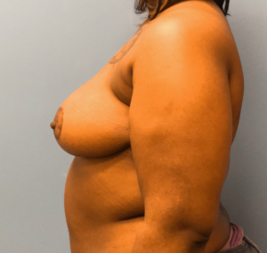 Breast-Reduction-Case--13002 | After Breast Reduction 2