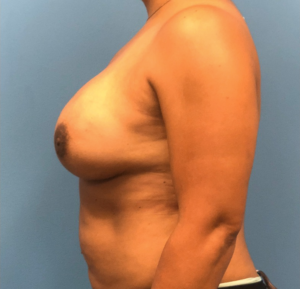 Case--11132 | After Breast Reconstruction 2