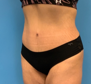 Abdominoplasty-Case--23747 | After Tummy Tuck 2