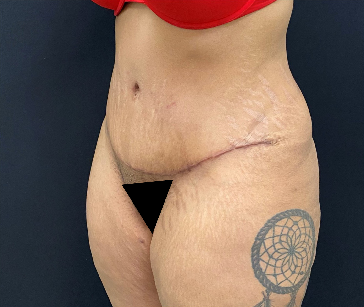 Liposuction-Tummy-Tuck-Case--338 | After Liposuction 2