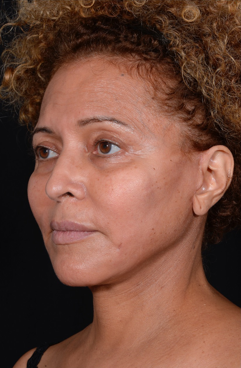 Facelift-Case--360 | After Facelift 2