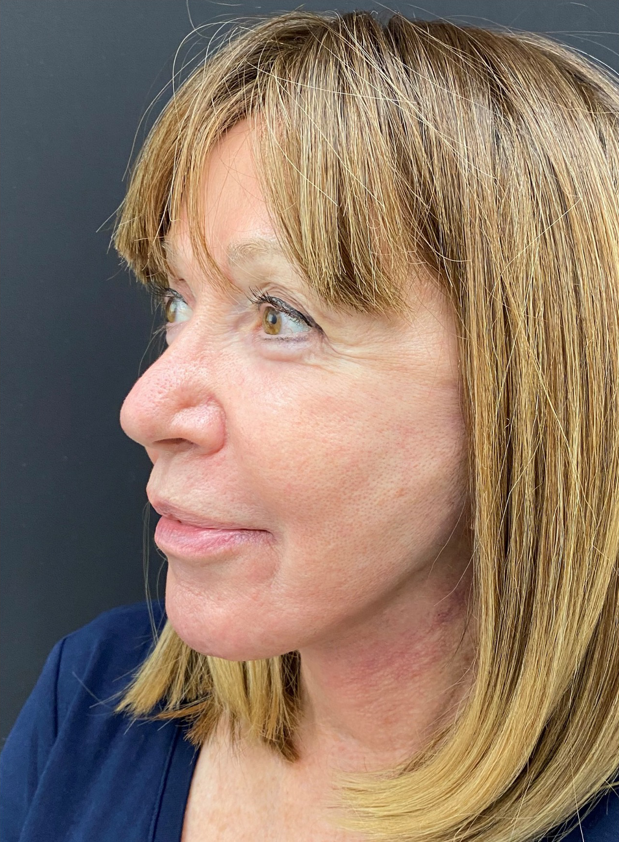 Facelift-Case--365 | After Facelift 2