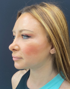 Facelift-Case--355 | After Facelift 2