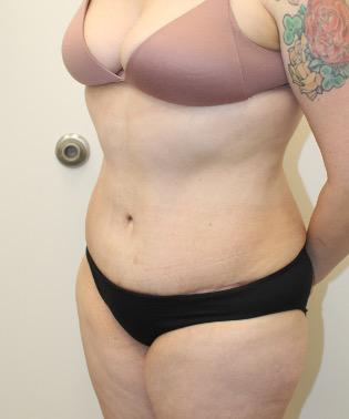 Liposuction-Tummy-Tuck-Case--343 | After Liposuction 2