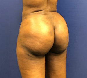 Brazilian-Butt-Lift-Case--267 | After Brazilian Butt Lift 1