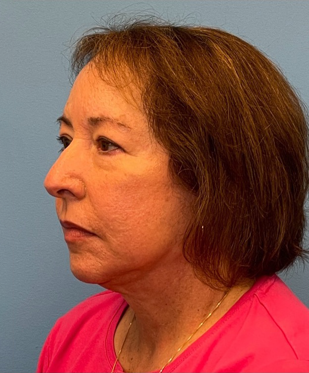 Facelift-Case--21241 | After Facelift 2