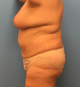 Mommy-Makeover-Case--39 | After Mommy Makeover 2