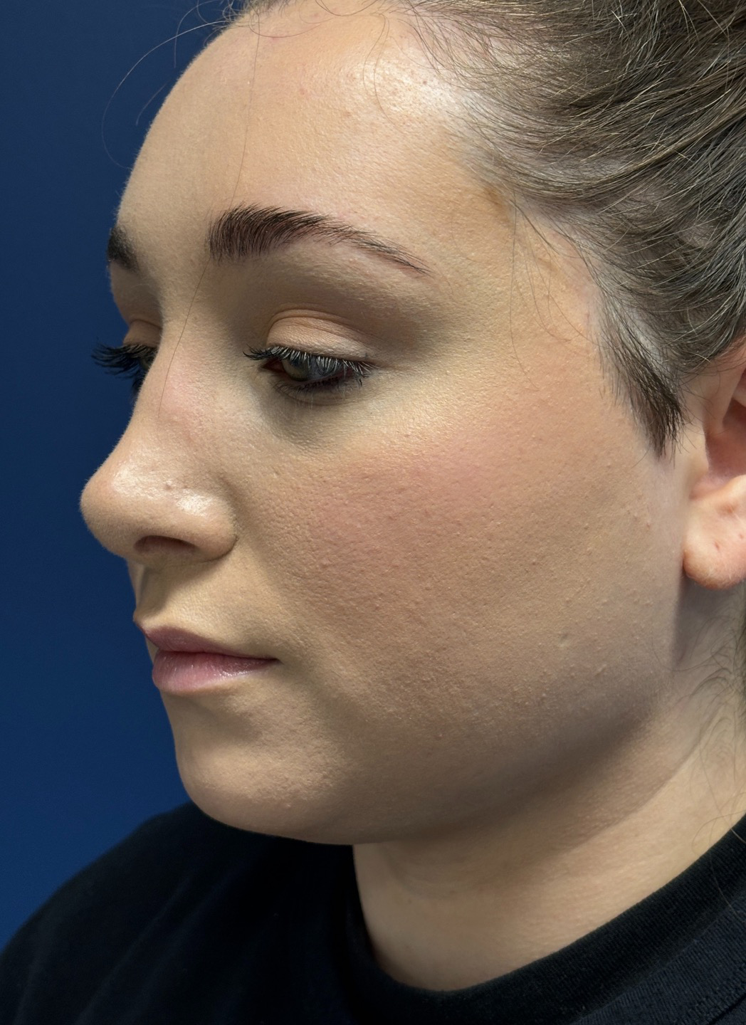 Submental-Liposuction-Case--29107 | After Liposuction 1