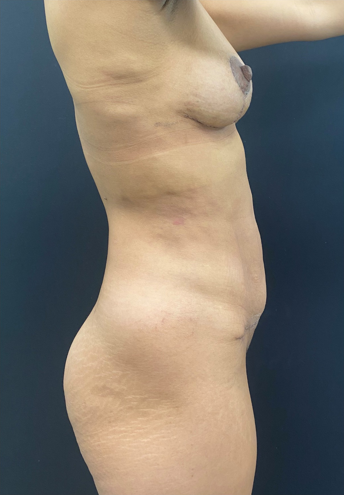 Mommy-Makeover-Case--384 | After Mommy Makeover 2