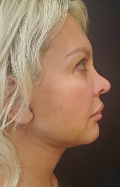 Facelift-Case--362 | After Facelift 2