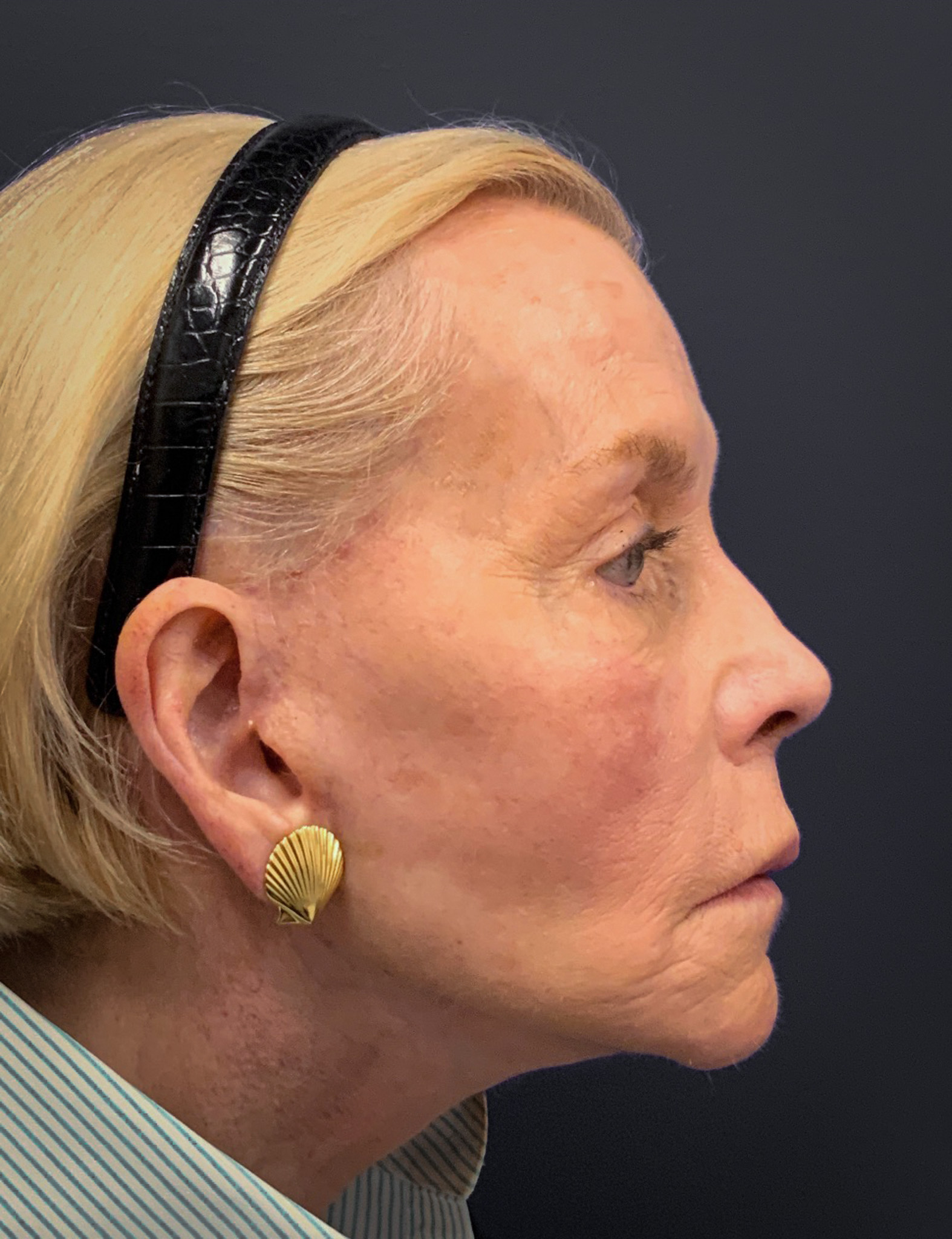 Facelift-Case--7247 | After Facelift 2