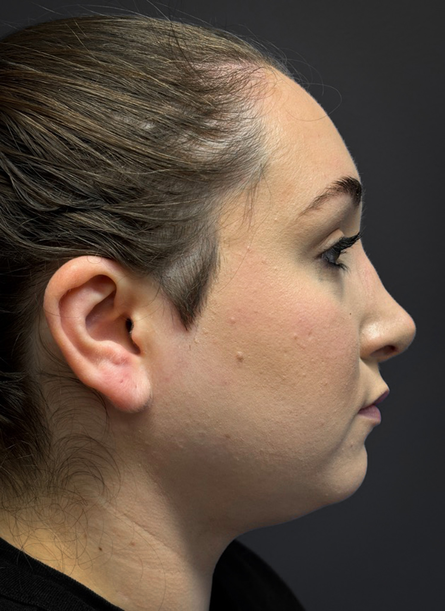 Submental-Liposuction-Case--3439 | After Liposuction 2