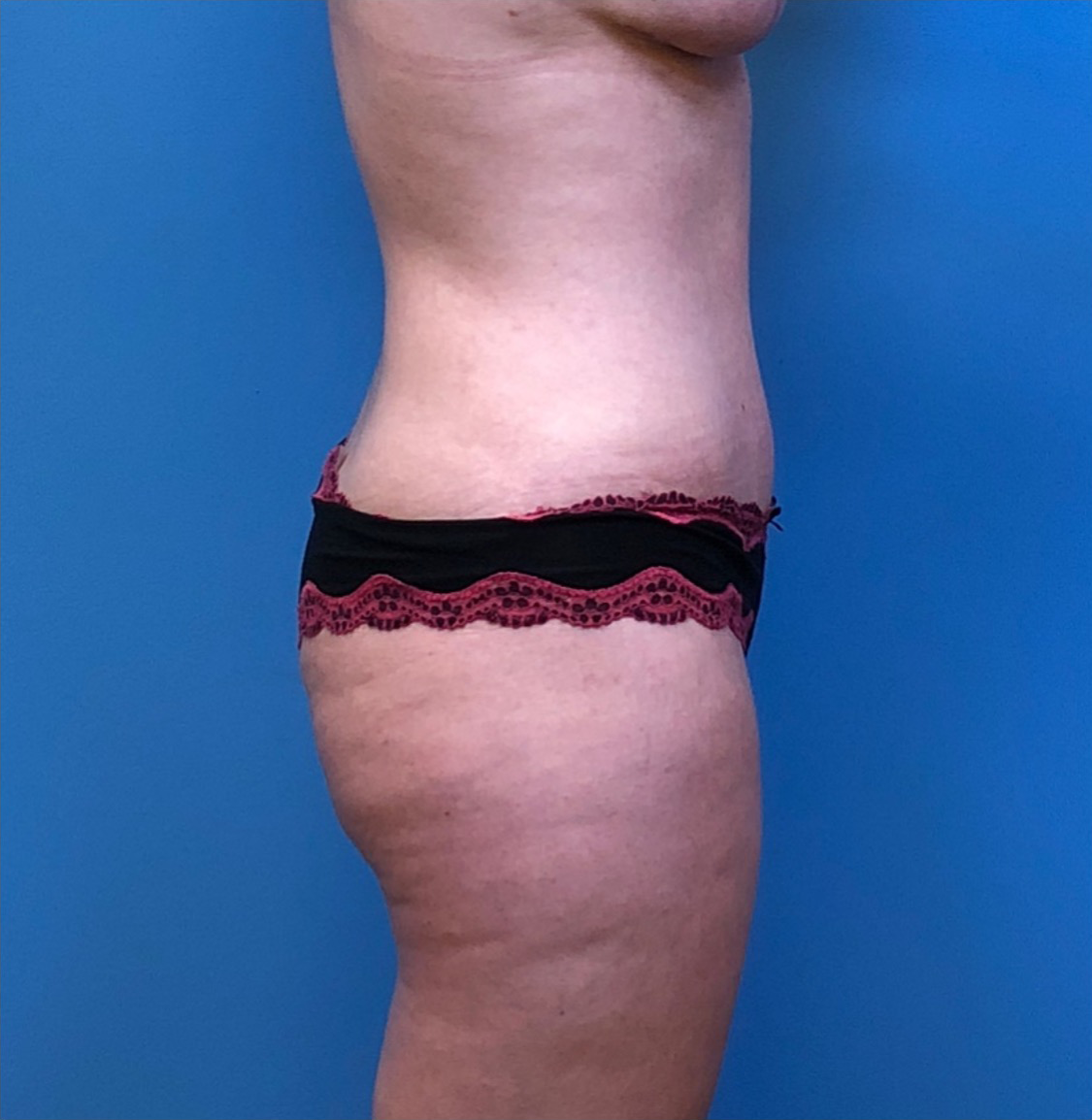 Abdominoplasty-Flank-Liposuction-Case--244 | After Liposuction 2
