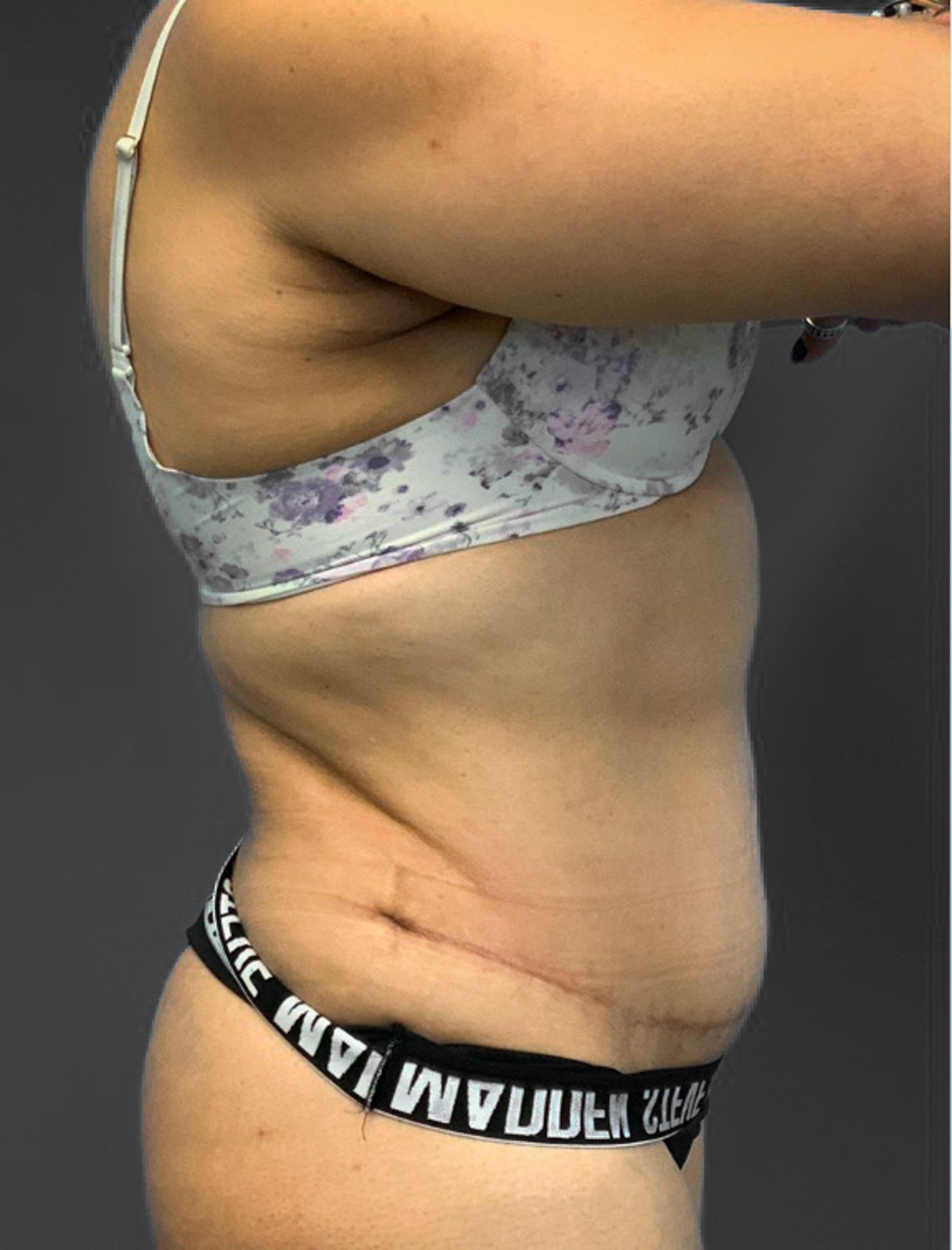Abdominoplasty-Case--2637 | After Tummy Tuck 2