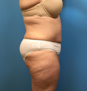 Case--249 | After Liposuction 2