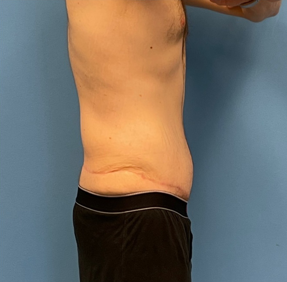 Body-Lift-Case--273 | After Tummy Tuck 2