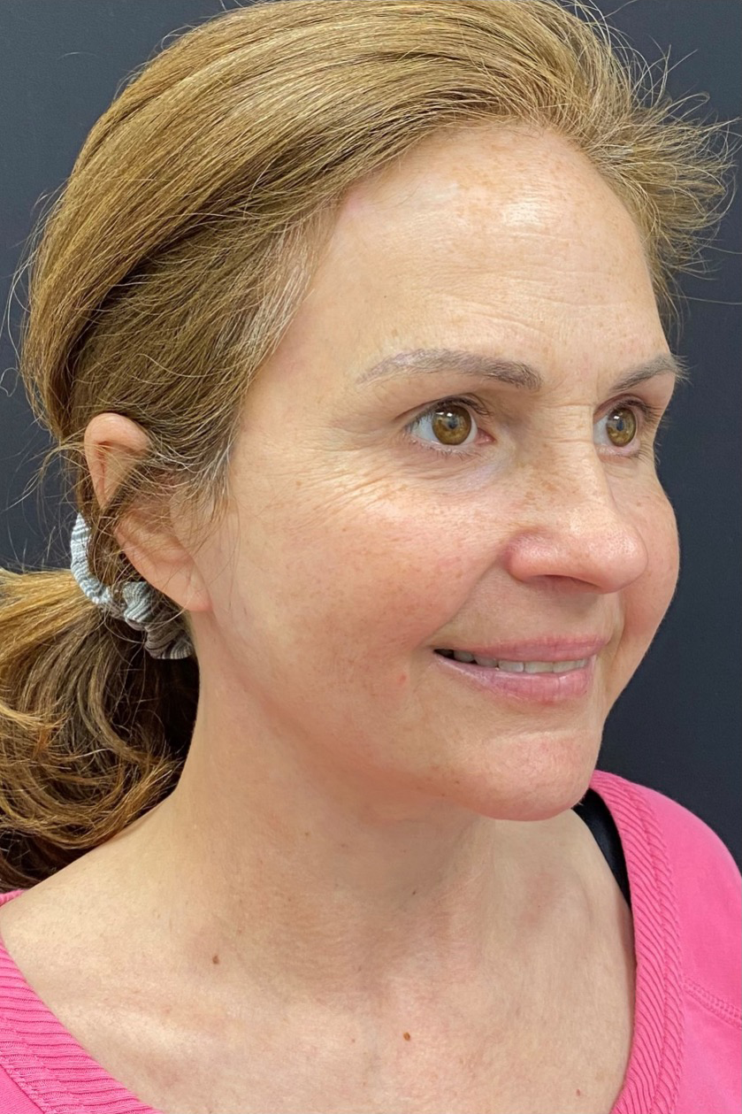 Facelift-Case--361 | After Facelift 2