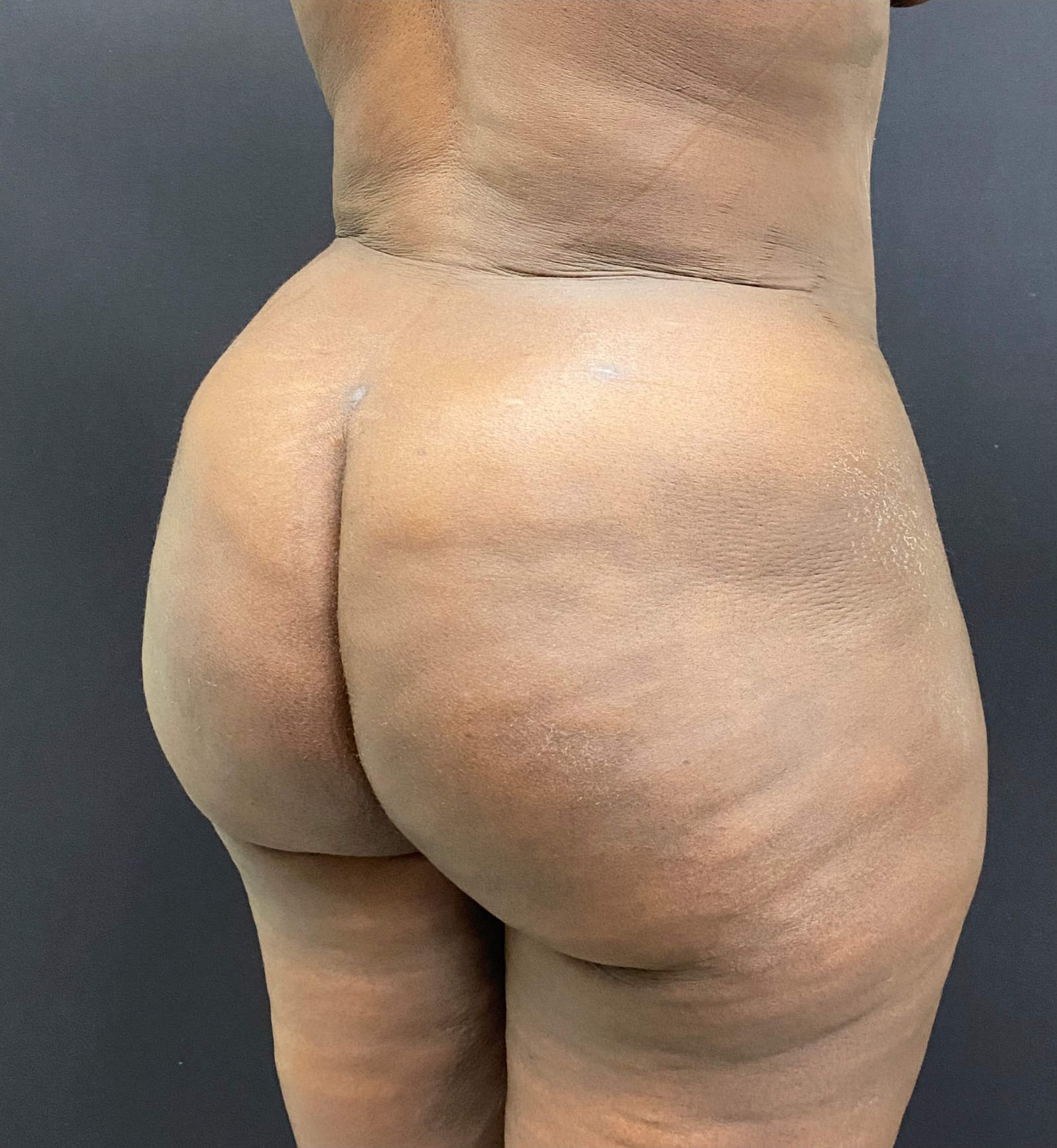 Brazilian-Butt-Lift-Case--353 | After Brazilian Butt Lift 2