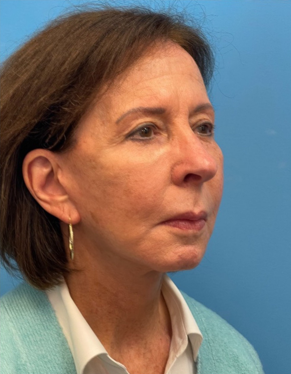 Facelift-Case--25941 | After Facelift 2