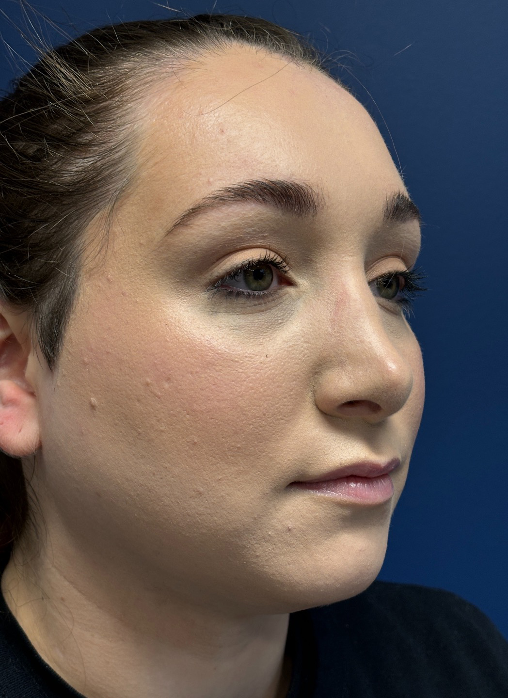 Submental-Liposuction-Case--29107 | After Liposuction 2