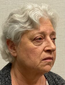 Rhinoplasty-Case--25467 | After Rhinoplasty 1