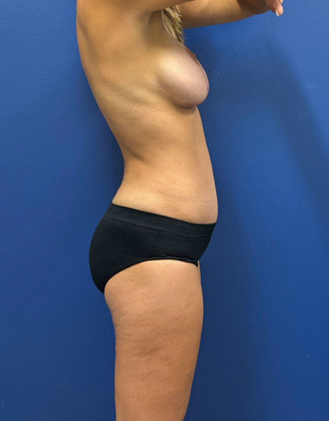 Breast-Augmentation-Tummy-Tuck-Case--29010 | After Breast Augmentation With Lift 7