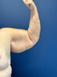 Brachioplasty-Case--5469 | Before Arm Lift 2