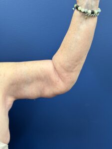 Brachioplasty-Case--5469 | After Arm Lift 2