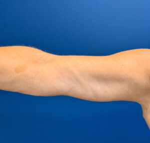 Brachioplasty-Case--2564 | After Arm Lift 2