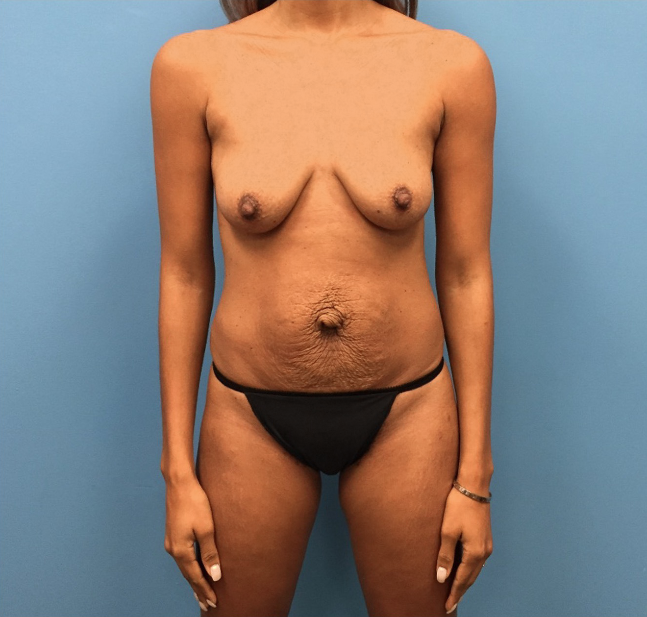 Mommy-Makeover-Case--262 | Before Mommy Makeover 1