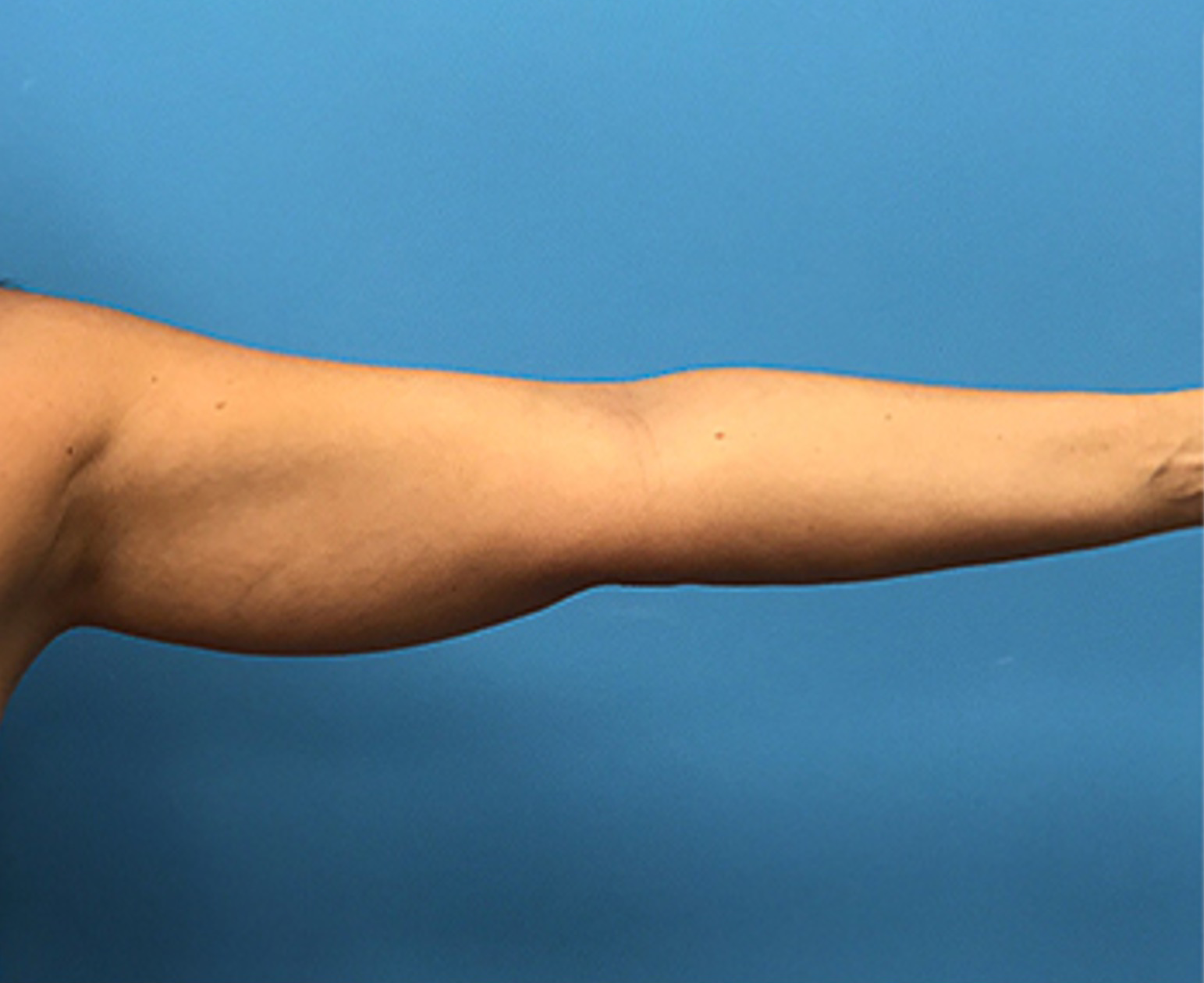 Liposuction-Case--72-2 | Before Liposuction 1