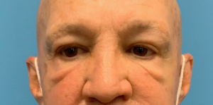 Blepharoplasty-Case--24169 | Before Dr. Arjun Kanuri 1