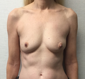 Breast-Reconstruction-Case--313 | Before Breast Reconstruction 1