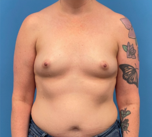 Breast-Reconstruction-Case--335 | Before Breast Reconstruction 1