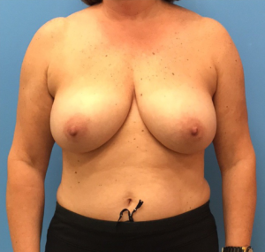 Case--314 | Before Breast Reconstruction 1