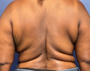 Body-Lift-Case--275 | Before Body Lift 1