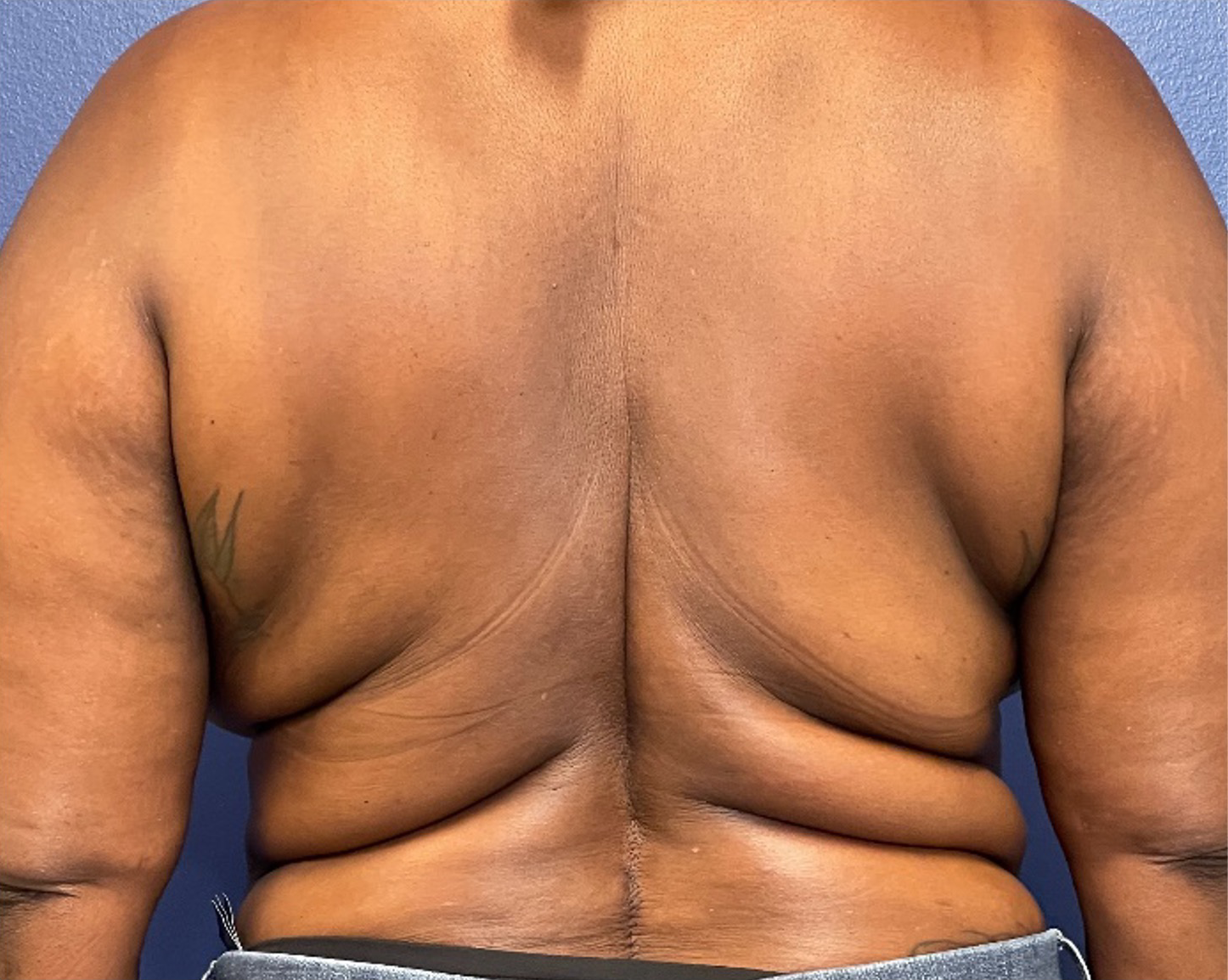 Body-Lift-Case--275 | Before Body Lift 1