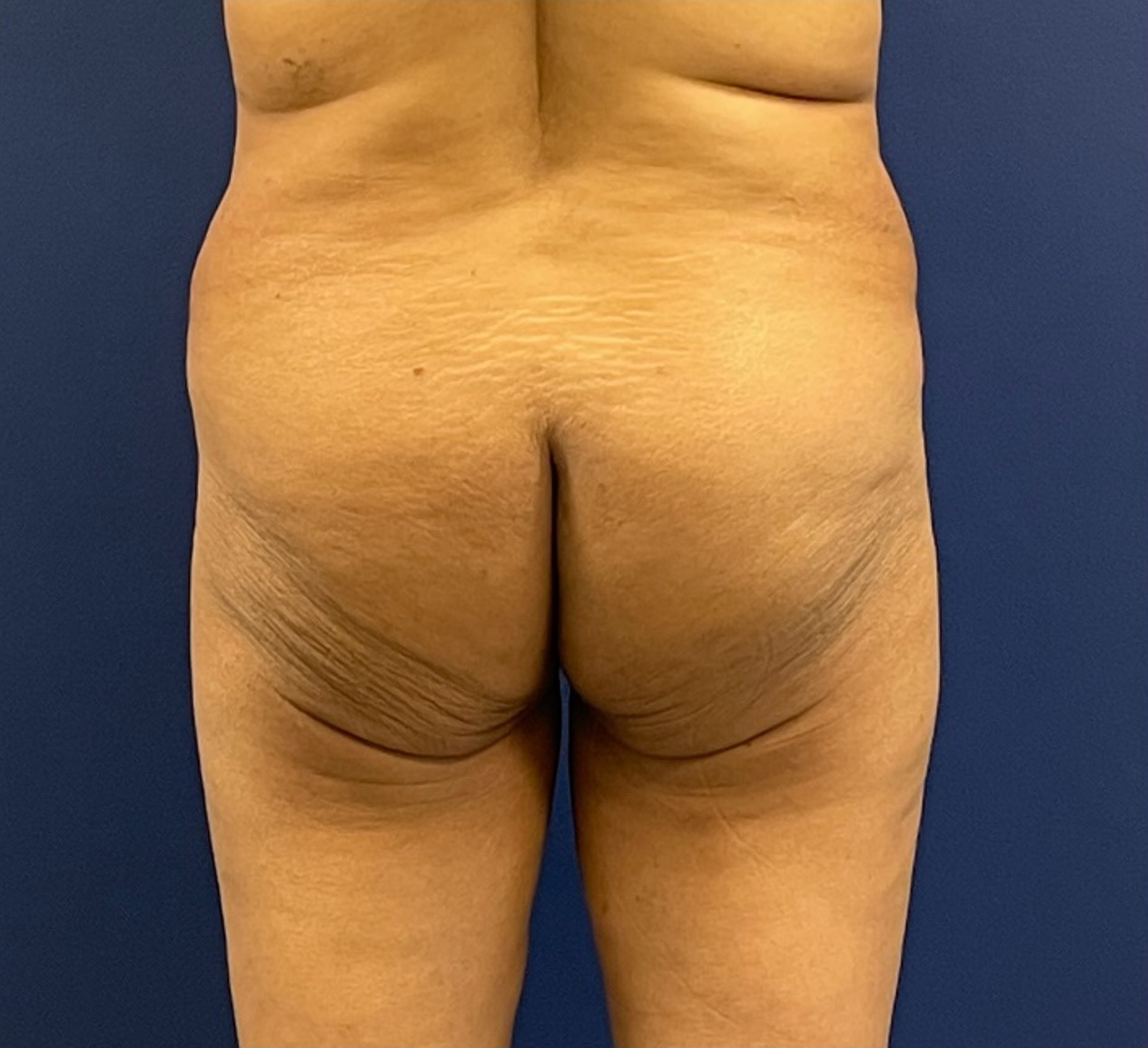 Brazilian-Butt-Lift-Case--215 | Before Brazilian Butt Lift 1