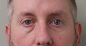Lower-Blepharoplasty-Case--359 | Before Dr. Arjun Kanuri 2