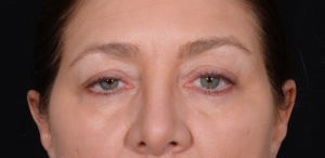 Quad-Blepharoplasty-Case--358 | Before Dr. Arjun Kanuri 2