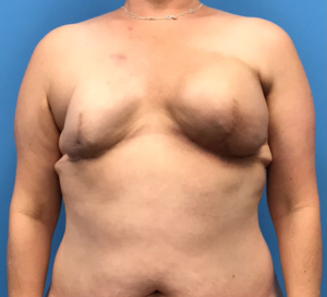 Case--10685 | Before Breast Reconstruction 1