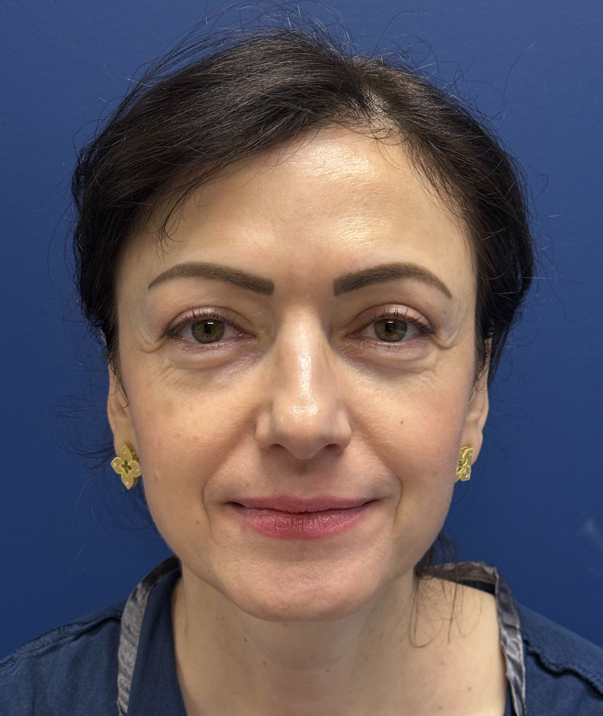 Lower-Blepharoplasty-Case--26939-1 | Before Eyelid Surgery 1