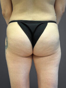 Aveli-Case--6987 | Before Aveli/AlloClae/J-Plasma 1